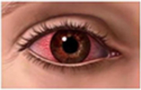 Dry Eyes & Dry Eye Syndrome