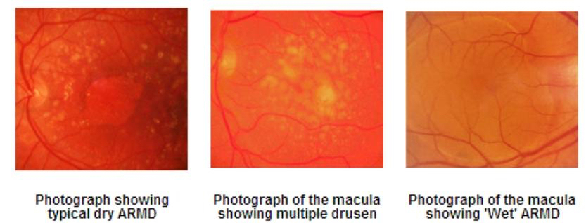What is macular degeneration?